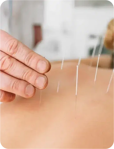 Acupuntura